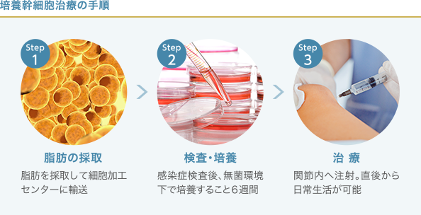 培養幹細胞治療の手順