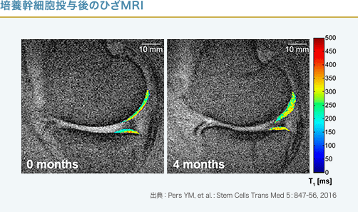 培養幹細胞治療後のひざのMRI画像