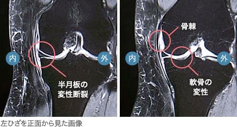 50代後半・女性／変形性膝関節症（初期）