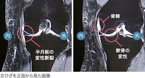 50代後半・女性/変形性膝関節症(初期)