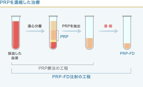 PRPとPRP-FD注射の工程の違い