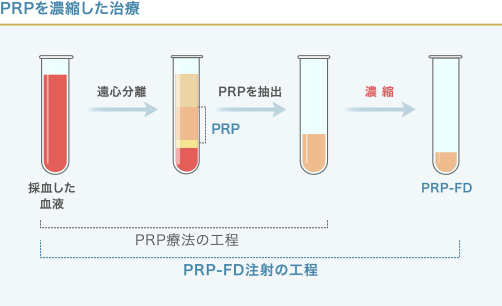 PRPとPRP-FD(PFC-FD)注射の工程の違い