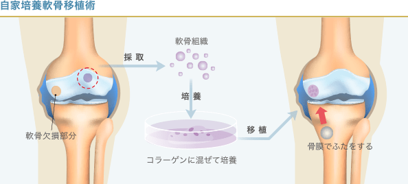 自家培養軟骨移植術の治療手順