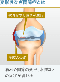 変形性ひざ関節症の病態