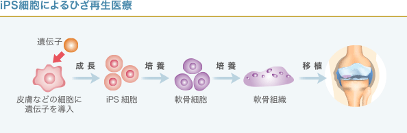 iPS細胞からのひざ軟骨移植の手順