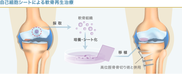 自己細胞シートによる軟骨再生治療の手順