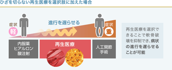 変形性ひざ関節症の進行と再生医療の関係