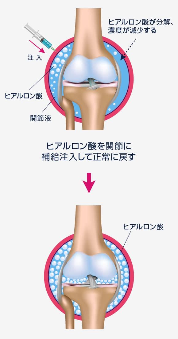 ヒアルロン酸注射の治療効果や費用｜横浜・神奈川の変形性 ...