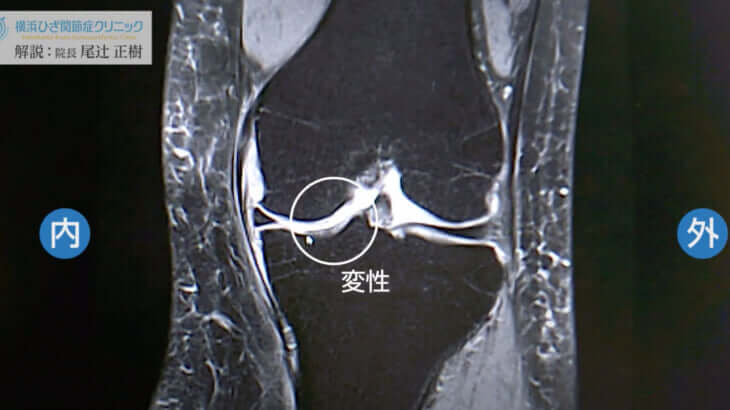 膝のMRIでわかること【半月板損傷】Dr. 尾辻の動画解説が好評 | 横浜院