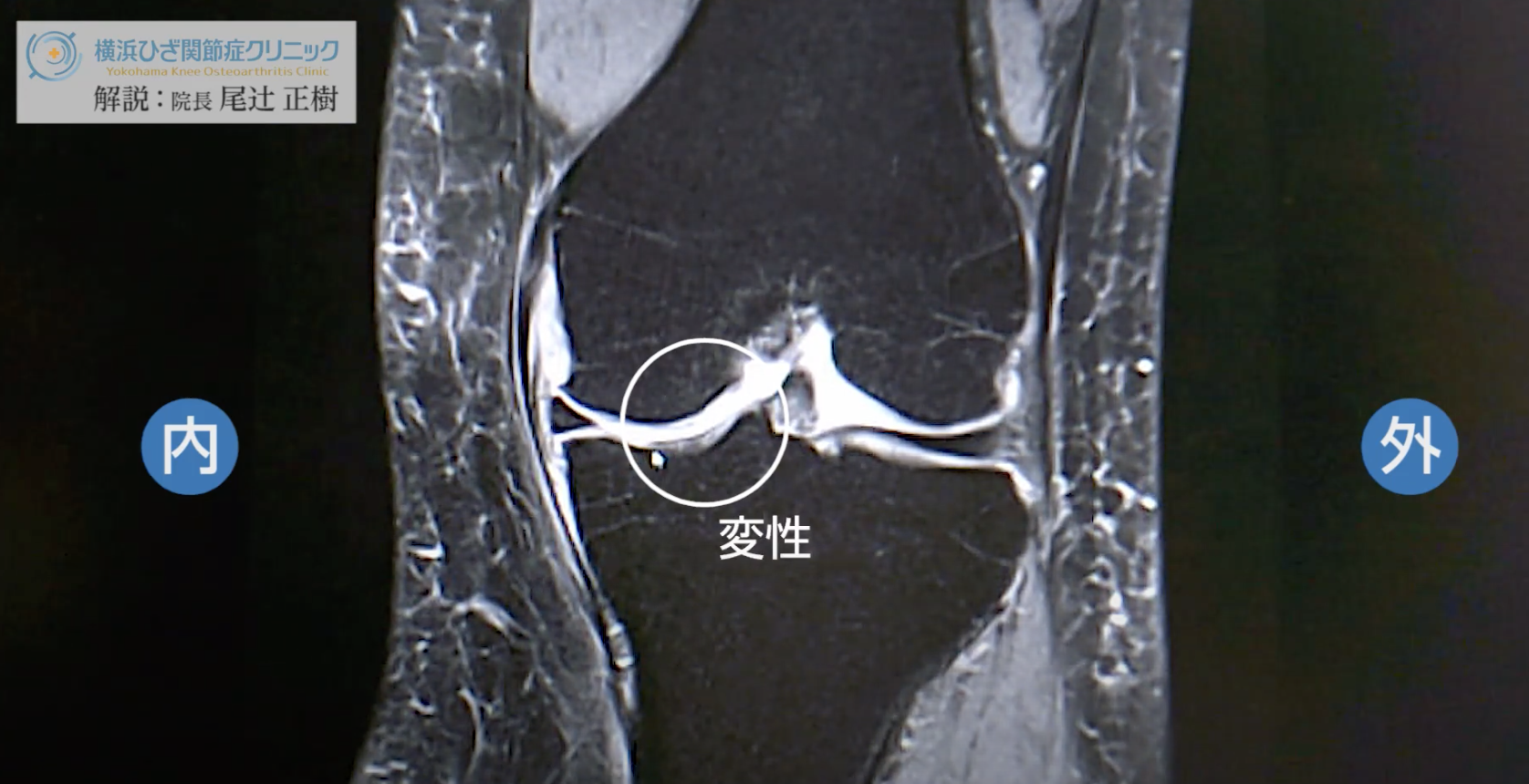 膝MRI画像（50代後半／初期の変形性膝関節症）